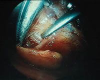 parathyroid surgery