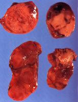 parathyroidectomy